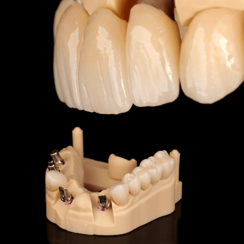 Close-up of dental prosthesis with artificial teeth and dental impression model.