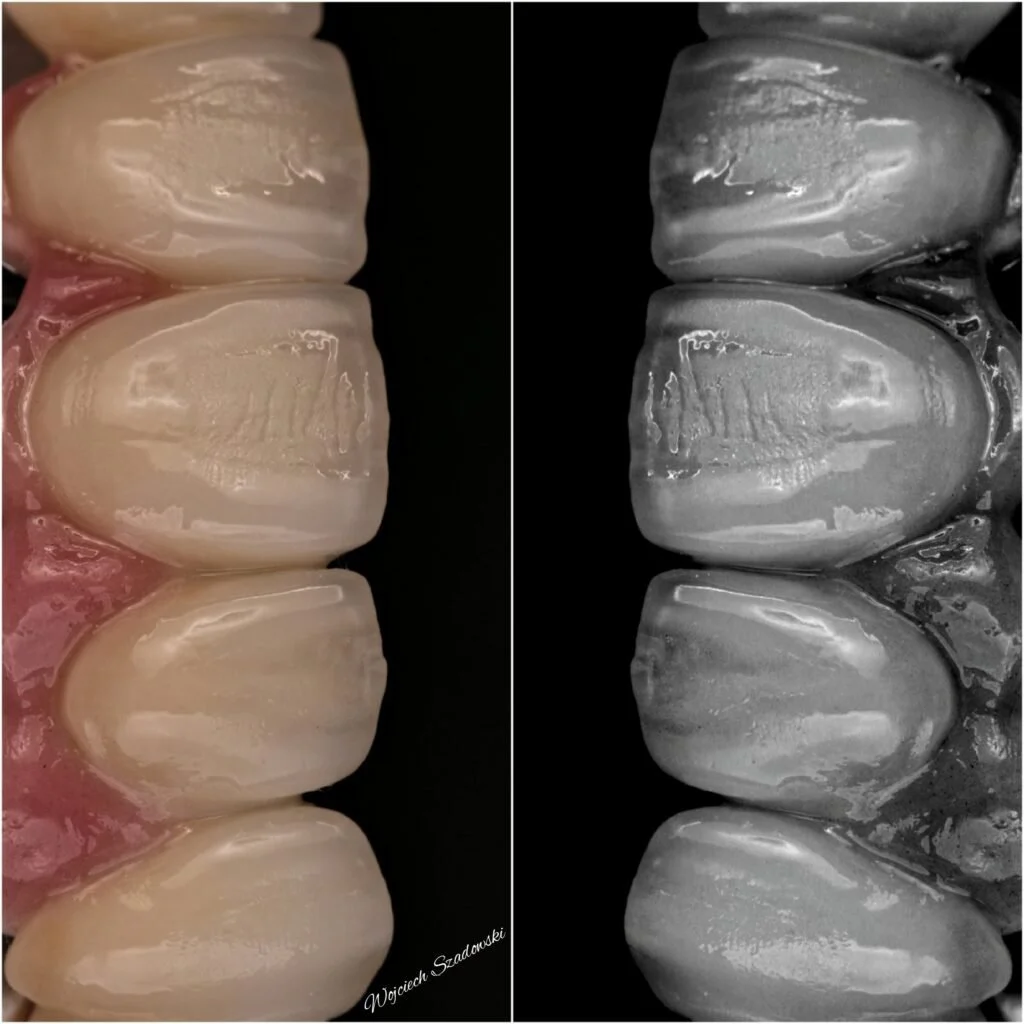 Close-up of a row of human teeth, with the left side in natural color and the right side in black and white, showing detailed tooth enamel and gum line.