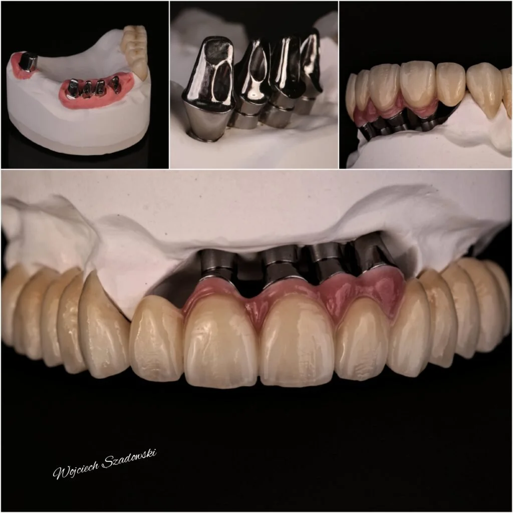 Dental prosthetics and crowns on dental molds, showcasing various types of dental restorations including bridges, implants, and crowns.
