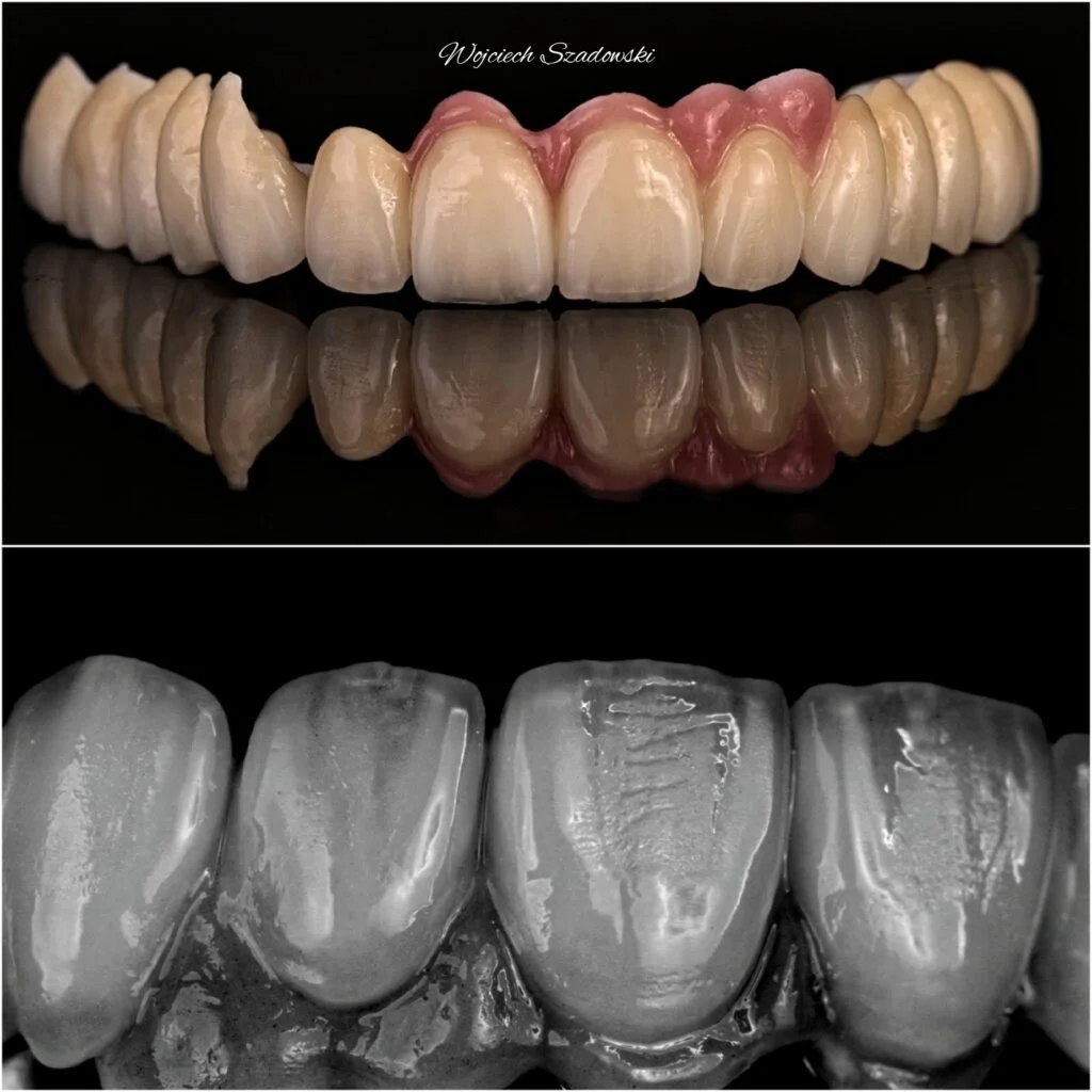 Close-up view of dental prosthetic teeth, with the upper row showing natural-looking teeth with pink gums and the lower row displaying a grayscale image of teeth and dental impressions.