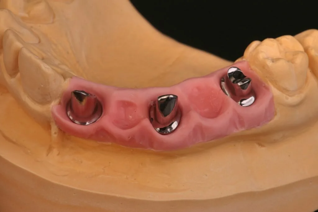 Dental implant model showing metal abutments for future crowns on a gum-colored base.