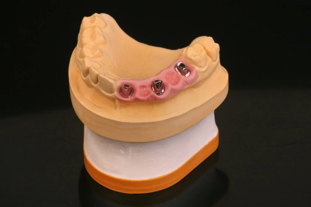 Dental model of a lower jaw with two dental implants and a pink gum tissue replica.