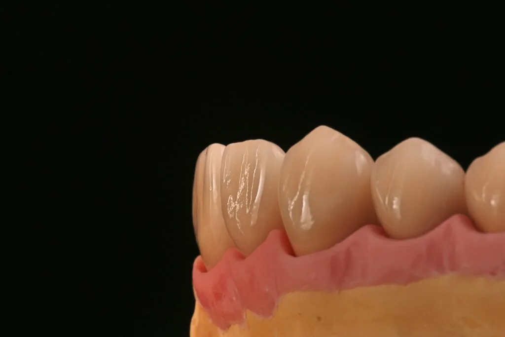 Close-up of a dental model showing natural-looking teeth and gums against a black background.