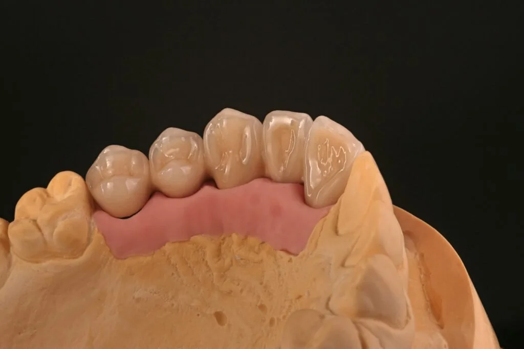 Dental model with metal crowns on upper teeth.