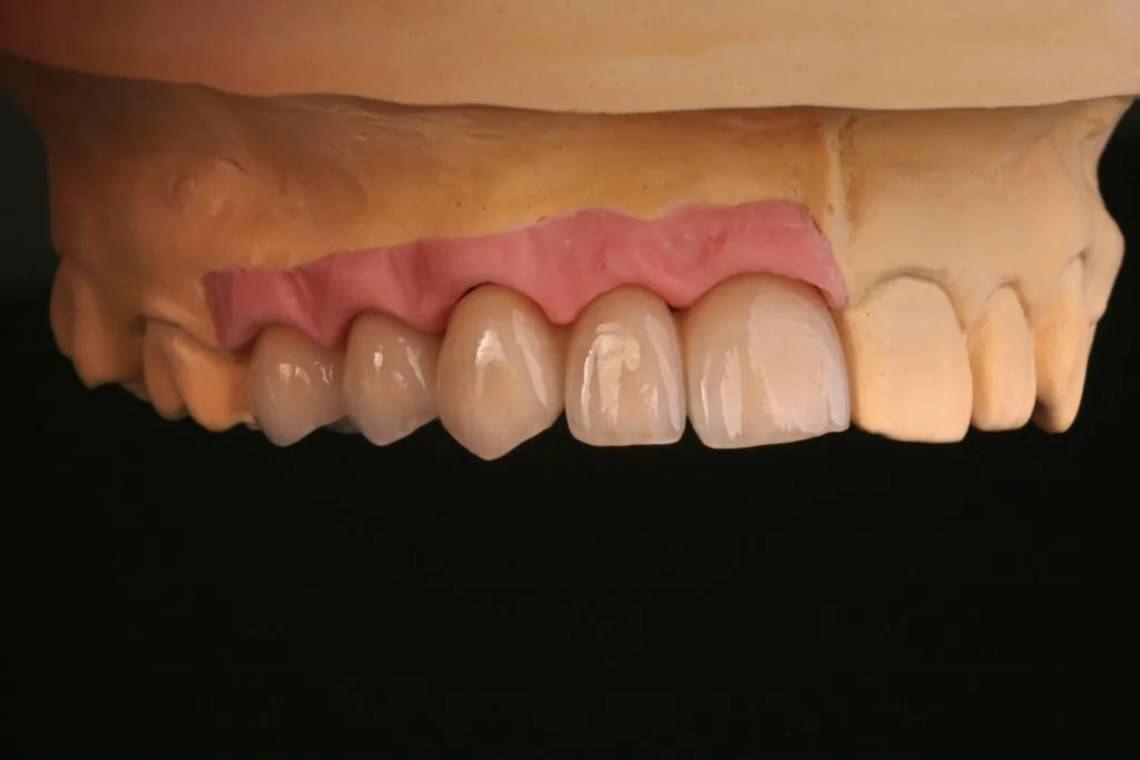 A dental model showing the upper front teeth with dentures or crowns, including natural and artificial teeth.