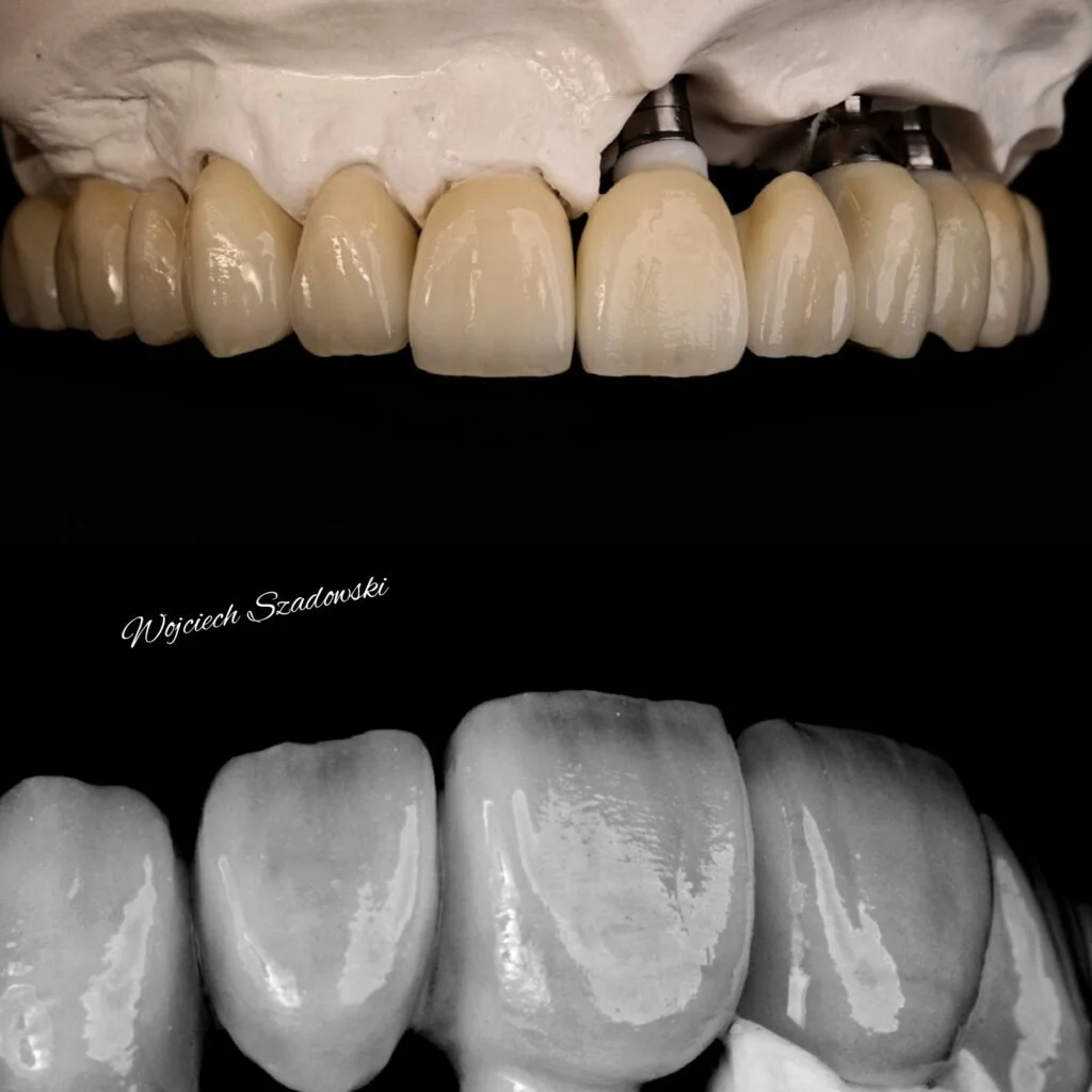 A close-up of a dental model showing upper and lower teeth, with the upper teeth exhibiting dental implants and crowns, and the lower teeth showing natural teeth with some wear.