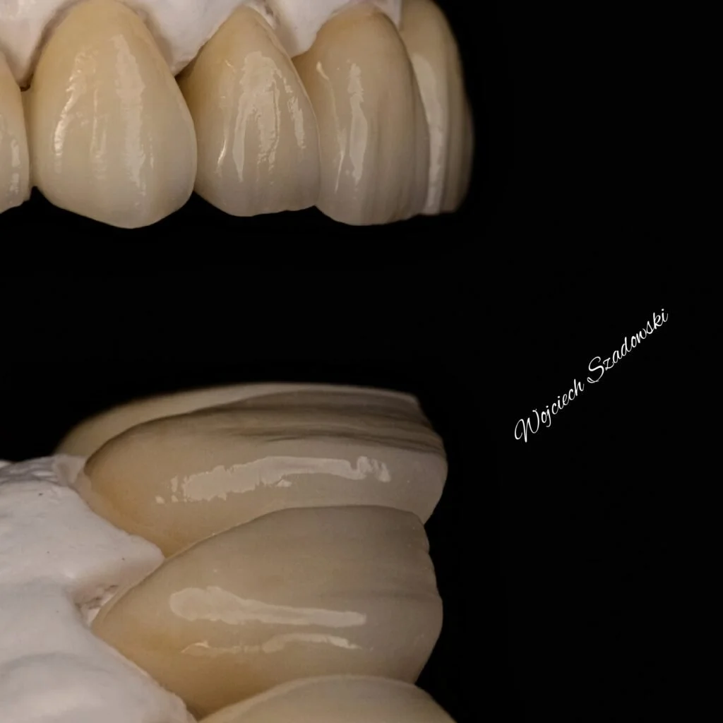 Close-up of a set of mounted human teeth, showing both the upper and lower teeth against a black background.