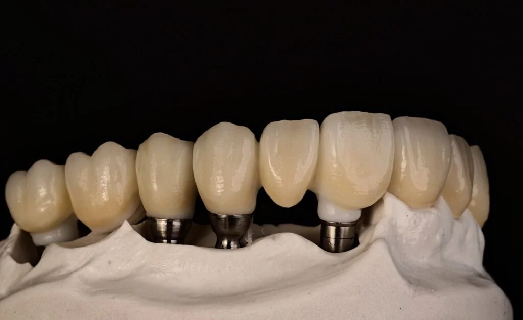 Dental prosthetic teeth with dental implants on a model.