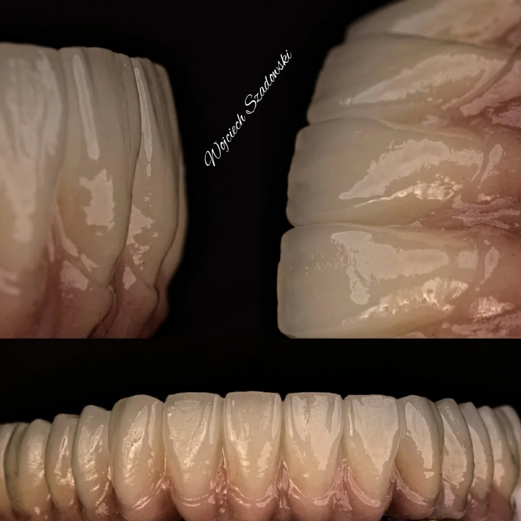 Close-up of a set of upper and lower human teeth with visible gums. The top row shows the back teeth, while the bottom row displays the front teeth.