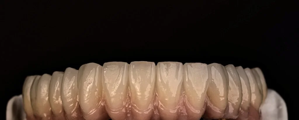 Close-up view of a set of upper teeth, showing the front teeth and gums.