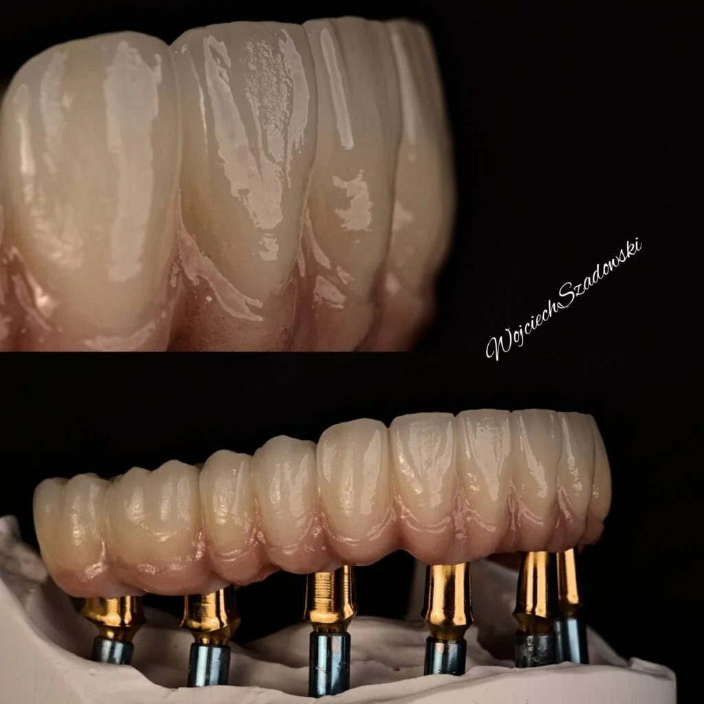 Close-up of dental prosthetic teeth, including a set of natural-looking teeth and a dental implant-supported bridge with gold-colored connectors