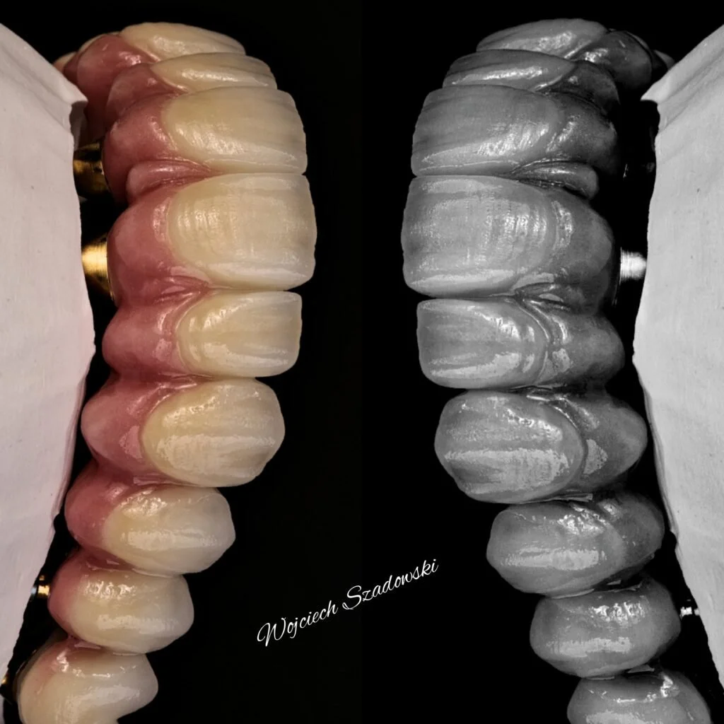 Close-up of two dental sets, one with natural teeth and the other with silver-colored dental crowns, displayed on black background with white paper on sides.