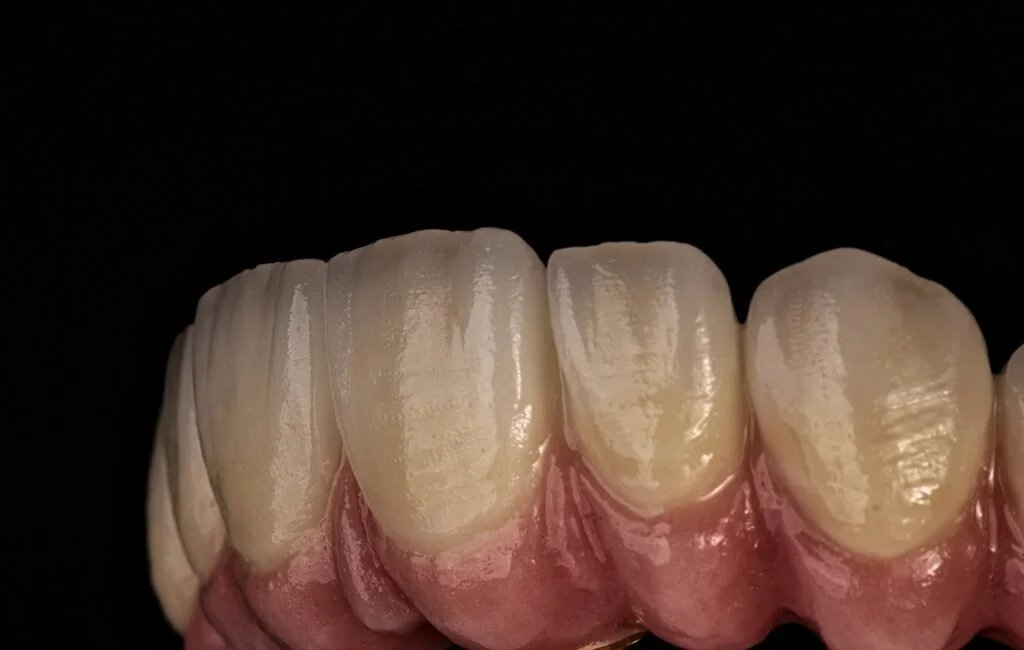Close-up of upper front teeth with dental veneers or crowns on a pink gum in a dark background.