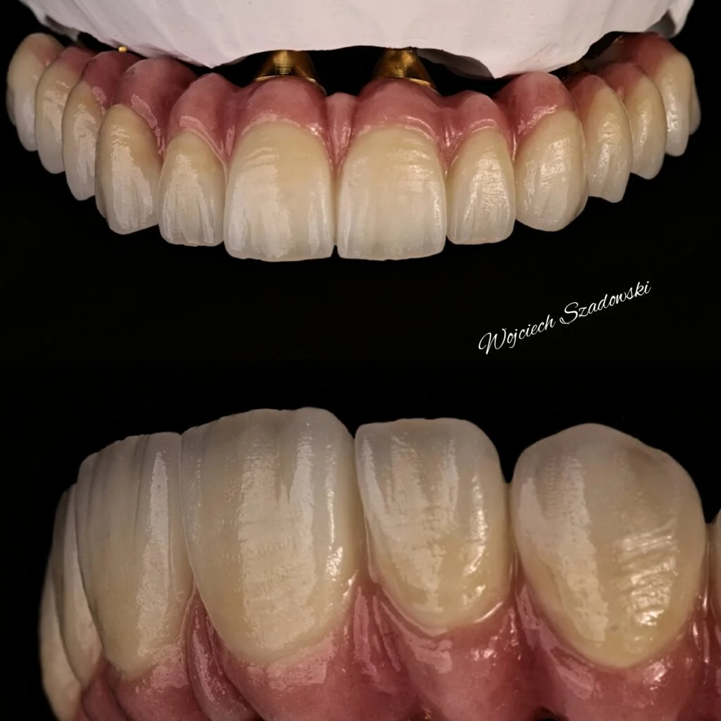 Close-up of upper teeth with dental implants and artificial teeth, showing the dental work and detailed enamel texture.