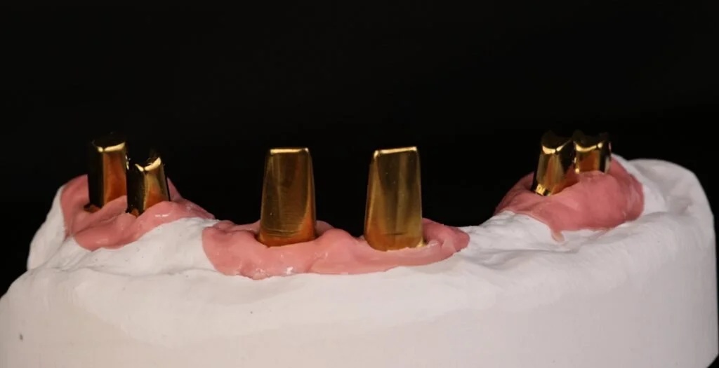 A dental model showing gold dental crowns on artificial teeth, with pink gum-like material in a white base against a black background.