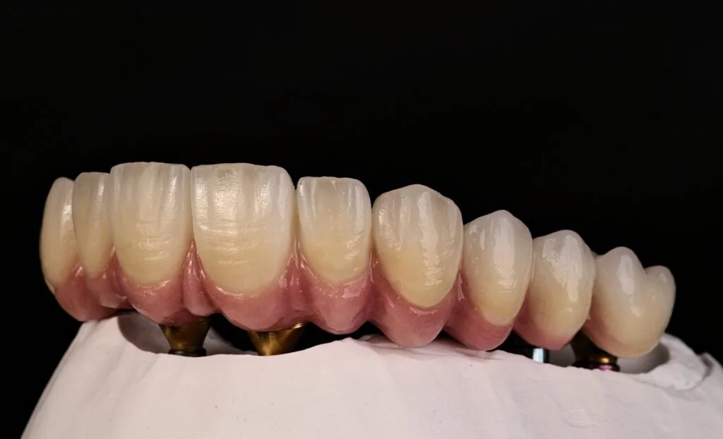A dental prosthetic with implanted artificial teeth on a white base against a black background.