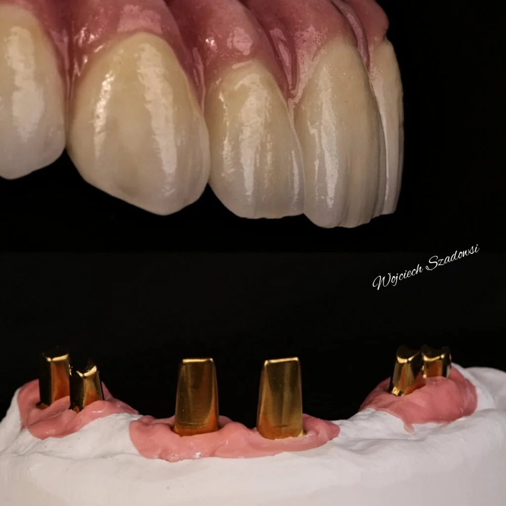 Close-up of a dental model showing upper front teeth and dental implants in the lower jaw. The upper teeth are natural, and the lower implants have gold-colored abutments. The background is black, and there is a signature that reads 'Wojciech Szadkow