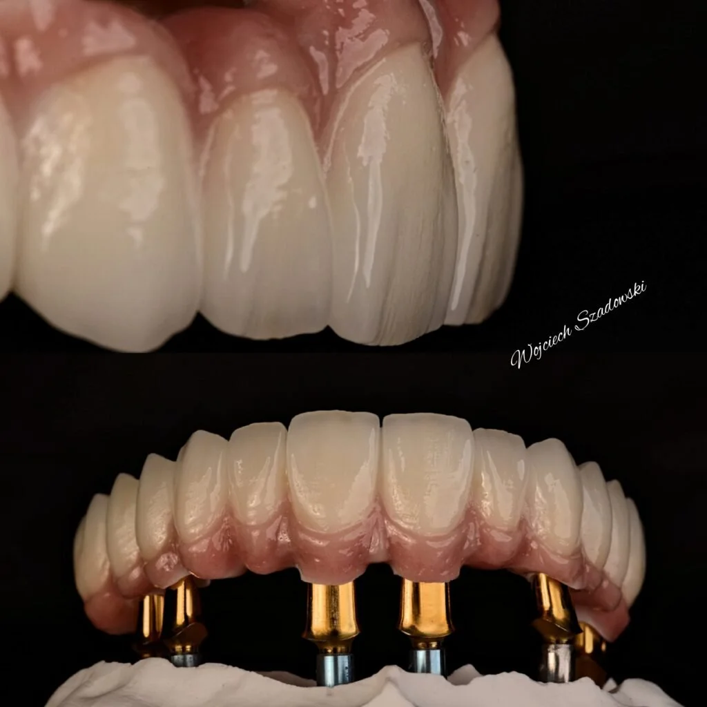 Close-up of dental implants and a dental prosthesis, showing a set of natural-looking teeth with dental crowns and metal implants beneath, against a black background.