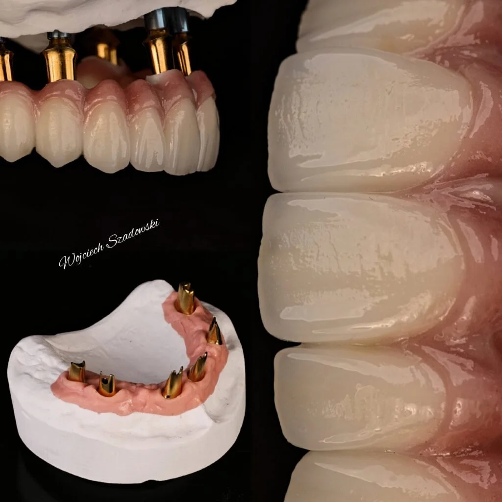 Close-up of dental prosthetics and dental implants, including a set of artificial teeth, a model with gold dental implants, and a dental impression showing replacement teeth.