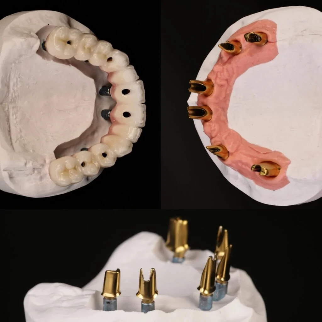 Three dental models displaying different stages of dental implant procedures, including metal implants and crowns.