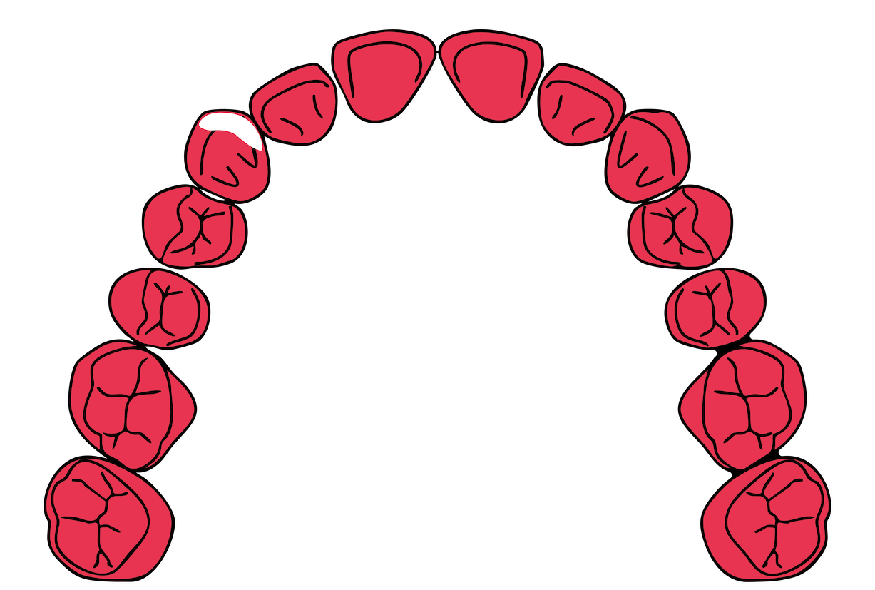 Illustration of a set of natural teeth arranged in an arch, with a crown on the front left tooth.