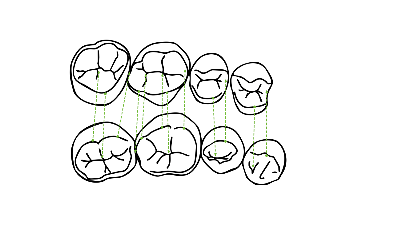 Diagram showing the stages of tooth decay in different teeth, with green dashed lines indicating the progression of damage.