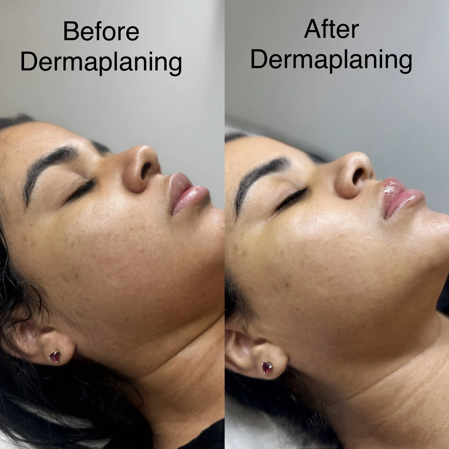Dermaplaning