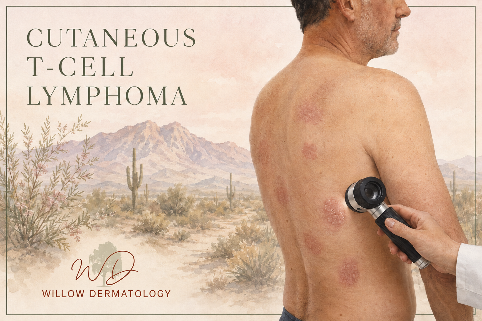 A man with cutaneous T-cell lymphoma having his back examined with a handheld skin scanner by a healthcare professional. The background features a desert landscape with cacti and mountains, along with the text 'Cutaneous T-Cell Lymphoma' and 'Willow Dermatology' logo.