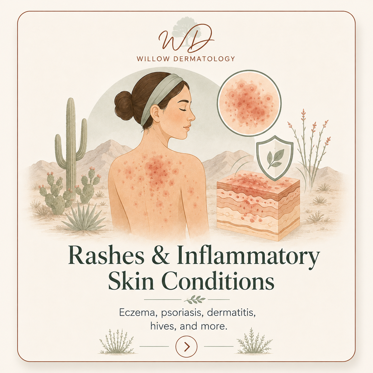 An illustration of a woman with skin rash on her back, with a desert landscape background including cacti and mountains, and a depiction of skin inflammation and skin layers, promoting skincare for rashes and inflammatory skin conditions.