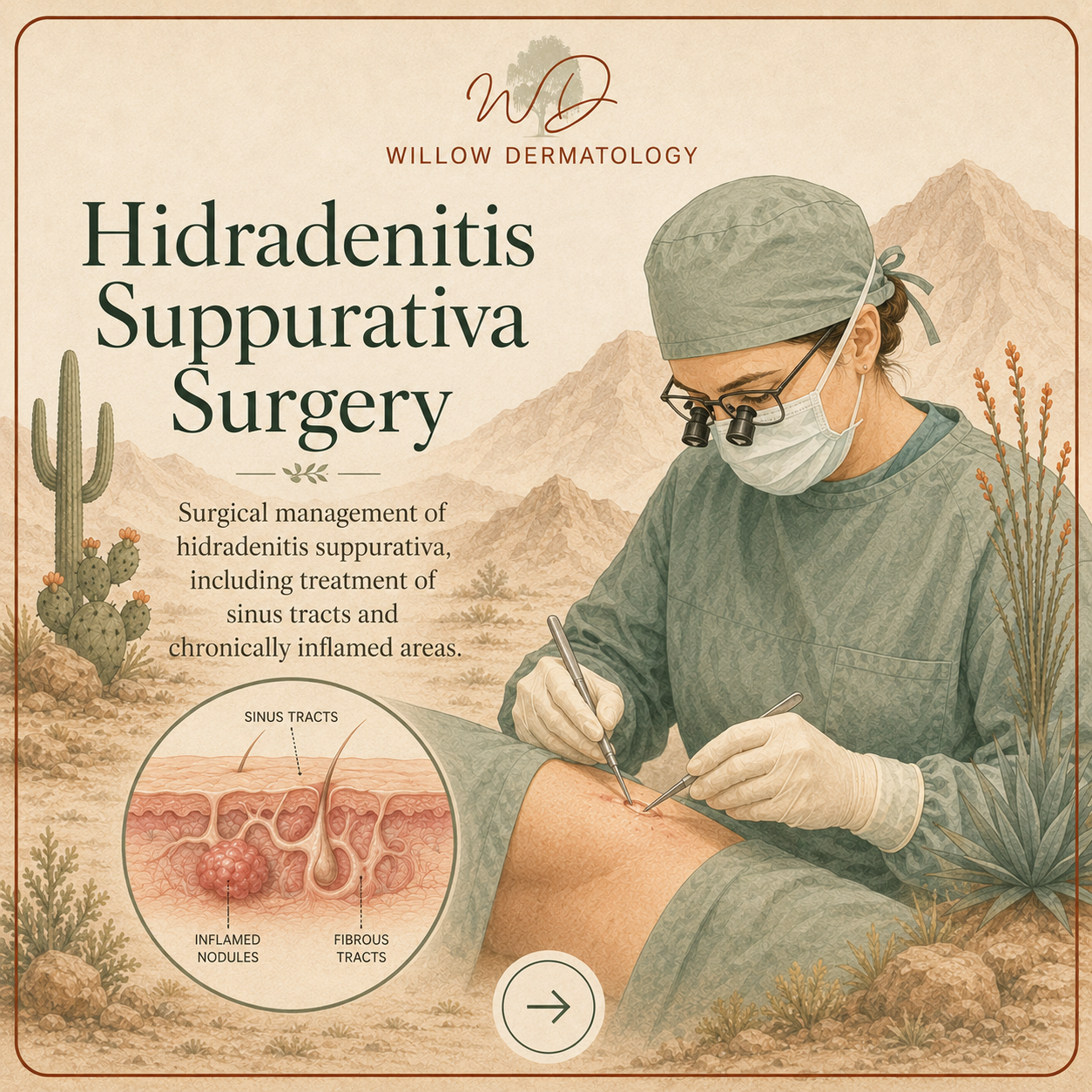 Illustration of a medical professional performing surgery on a patient's arm, focusing on treatment of hidradenitis suppurativa, with desert landscape and cacti in the background, and a diagram of affected skin with inflamed nodules and sinus tracts.