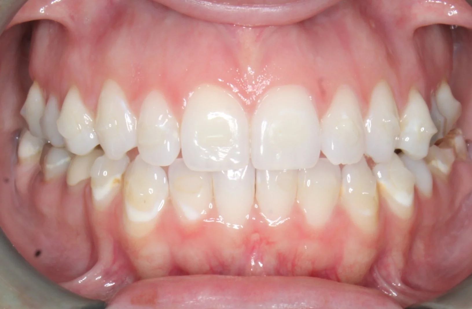 Close-up of a person's upper and lower teeth, showing signs of crowding and misalignment.