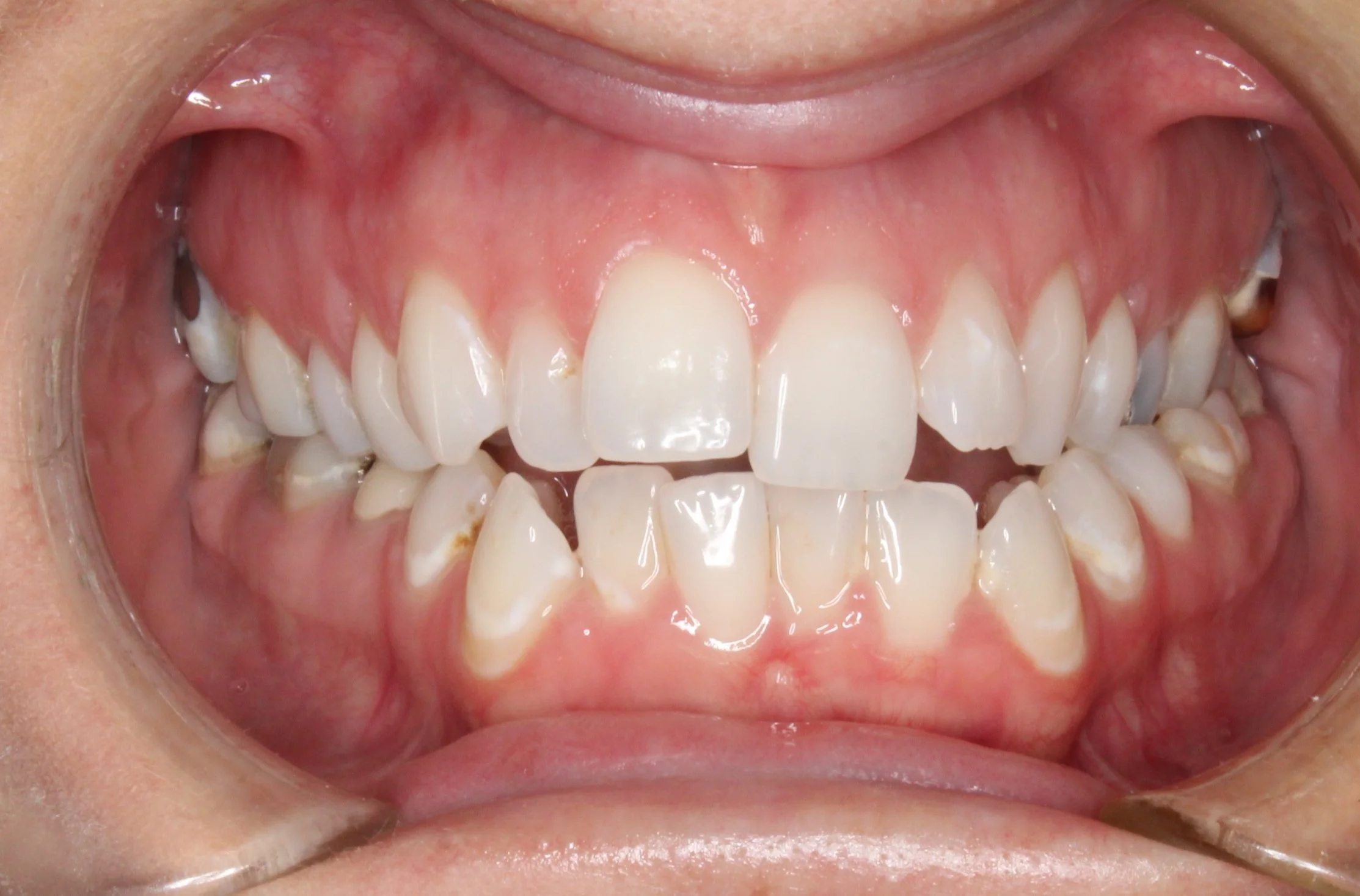 Close-up of open mouth showing upper teeth, gums, and lower teeth with some plaque and tartar buildup.