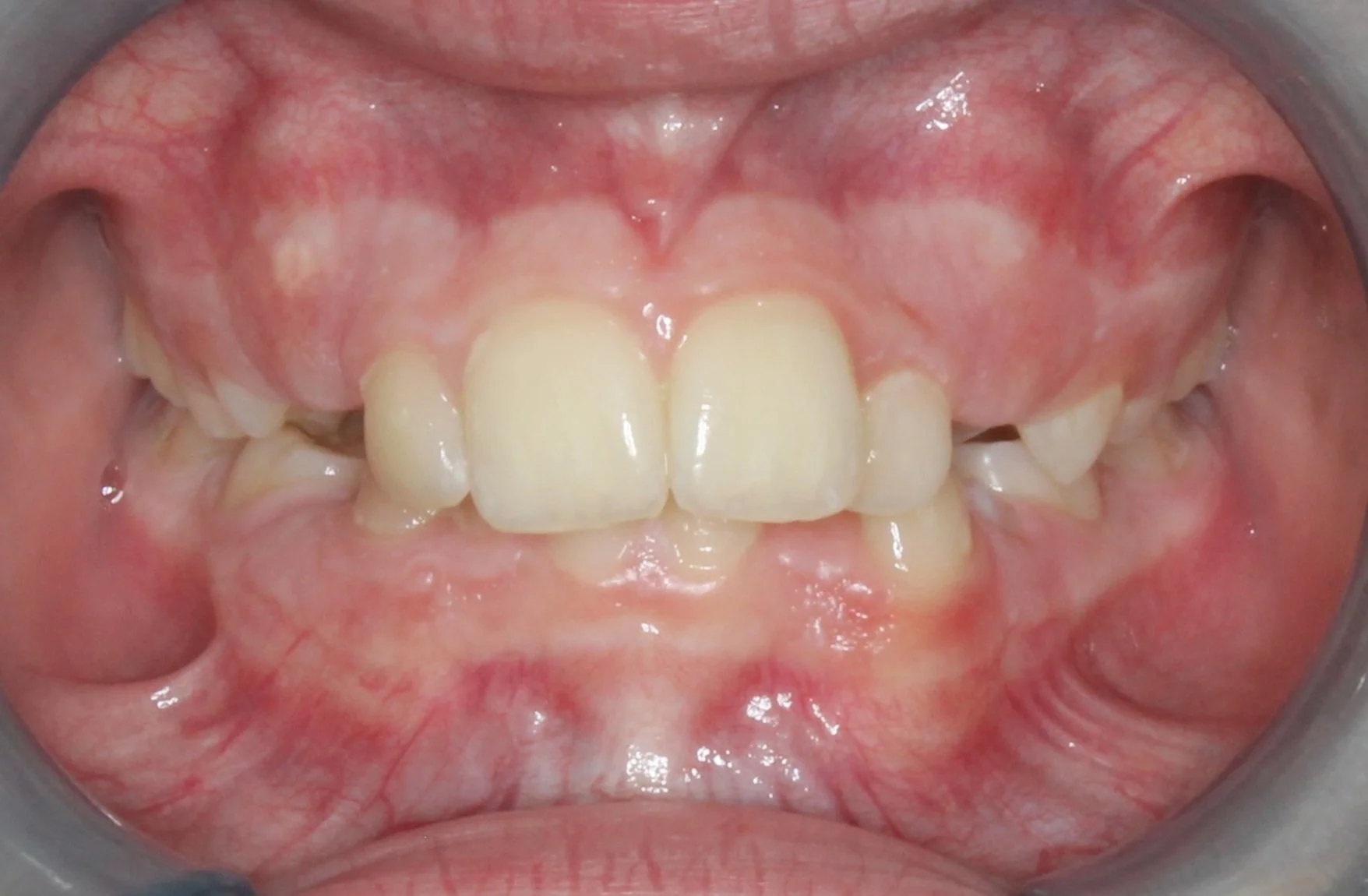 Close-up of a person's mouth showing upper and lower teeth with dental issues including misalignment and uneven spacing.