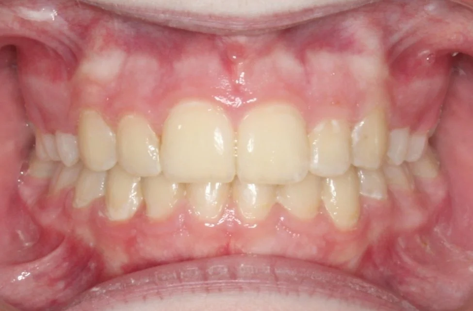 Close-up of a person's mouth showing teeth with crowding and misalignment.