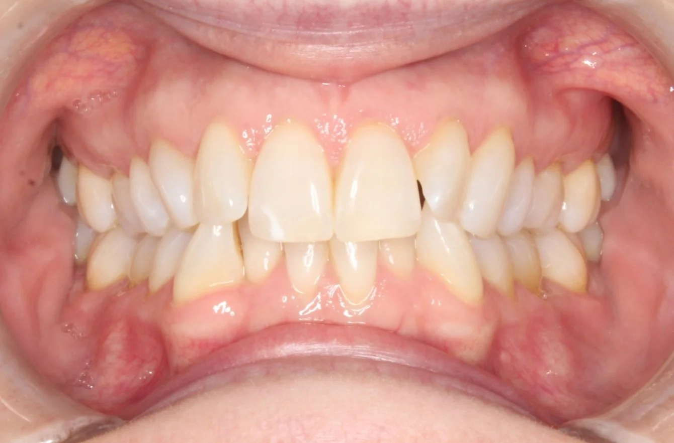 Close-up of a person's open mouth showing teeth, gums, and oral mucosa, with signs of dental crowding and mild gum inflammation.