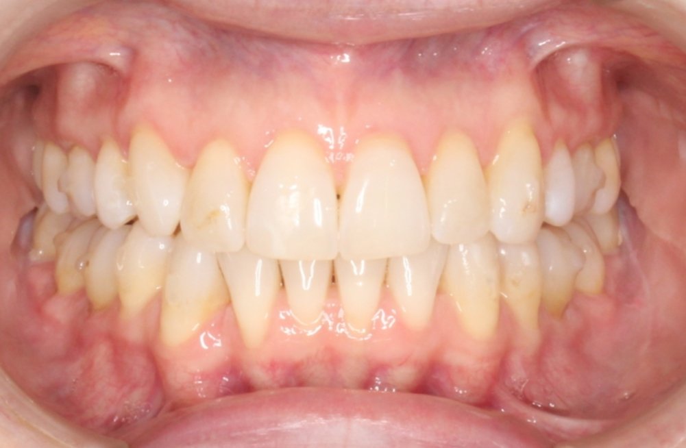 Close-up of a person's teeth showing misalignment and crowding, with some discoloration.
