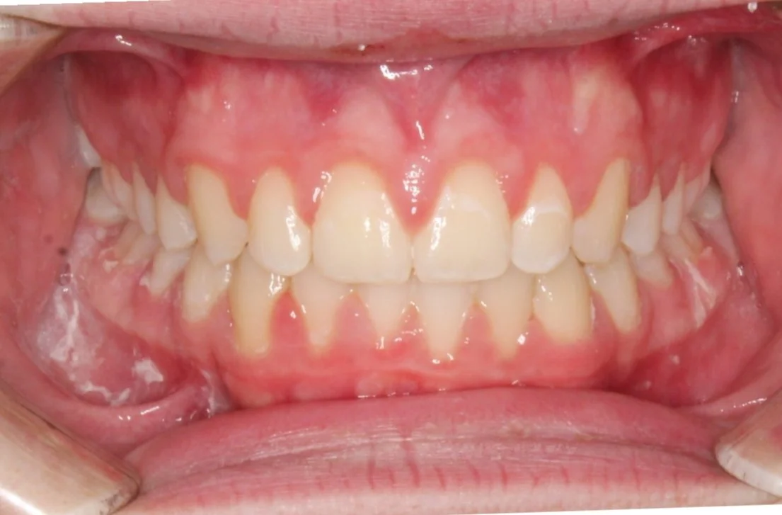 Close-up of a person's open mouth showing crowded and misaligned teeth with gingivitis.