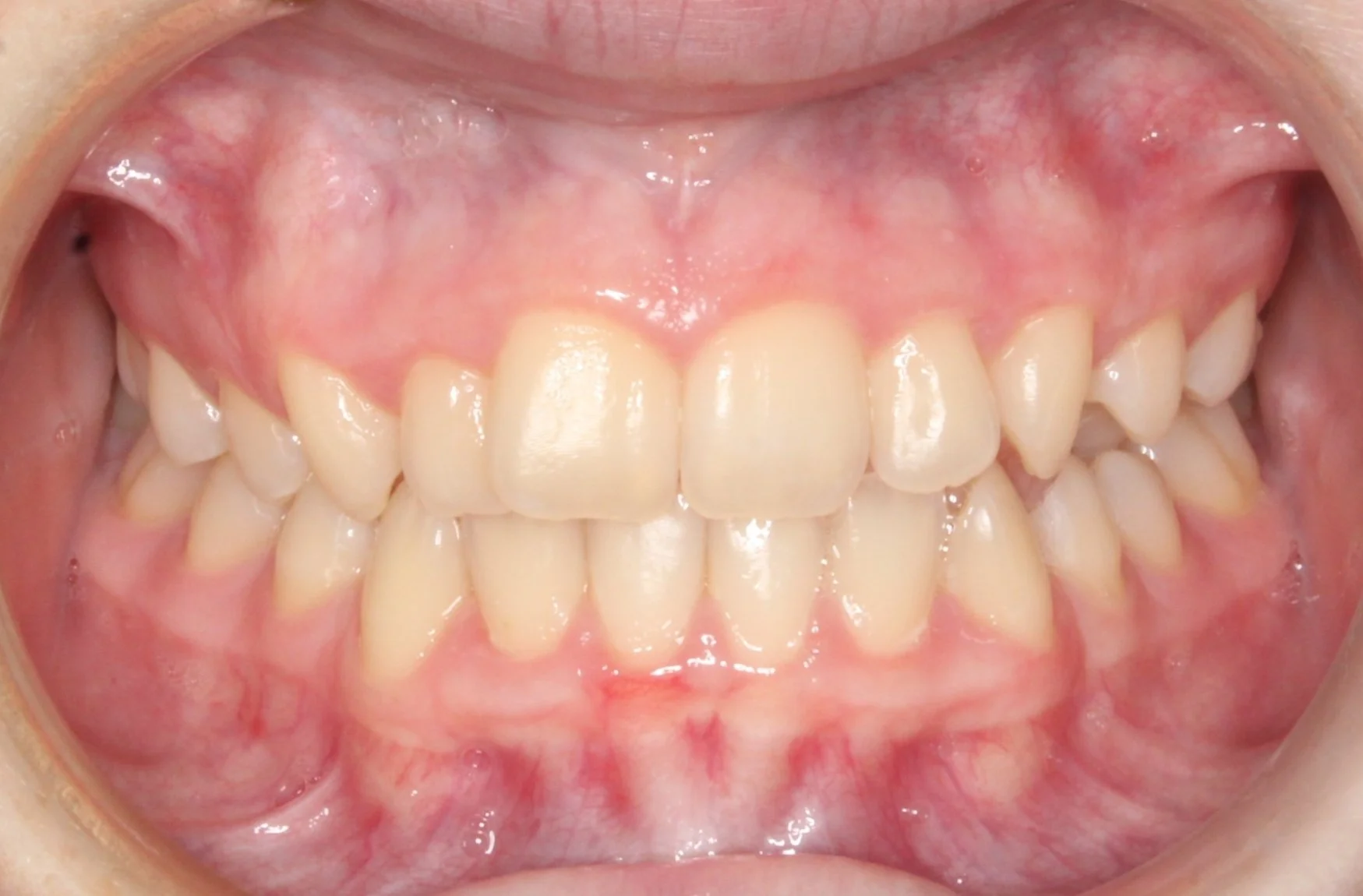 Close-up of a person's open mouth showing upper and lower teeth with some crowding and misalignment.