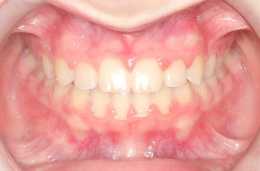 Close-up of a child's mouth showing teeth with misalignment and crowding.