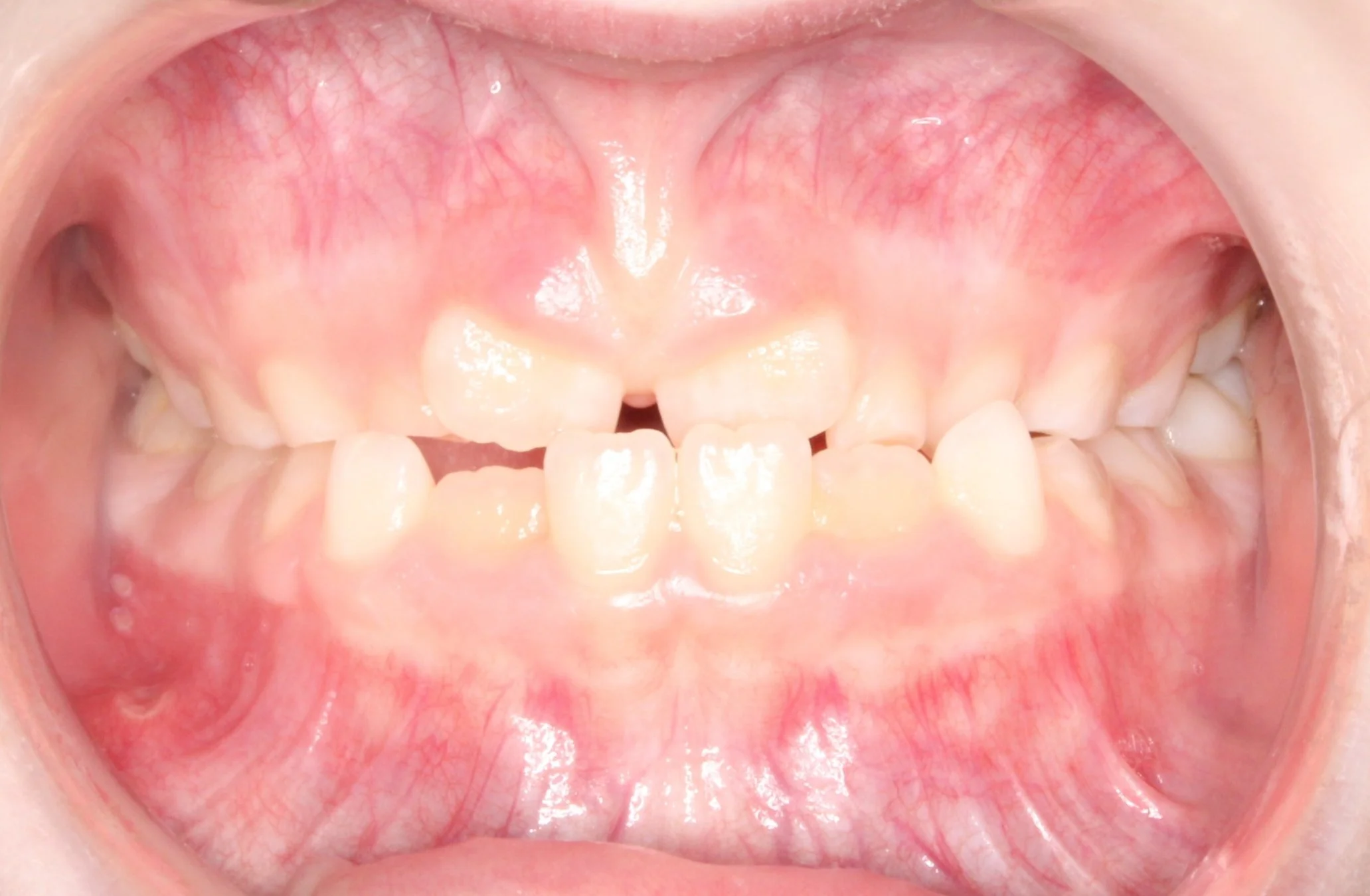 Close-up of an open mouth showing teeth and pink gums.