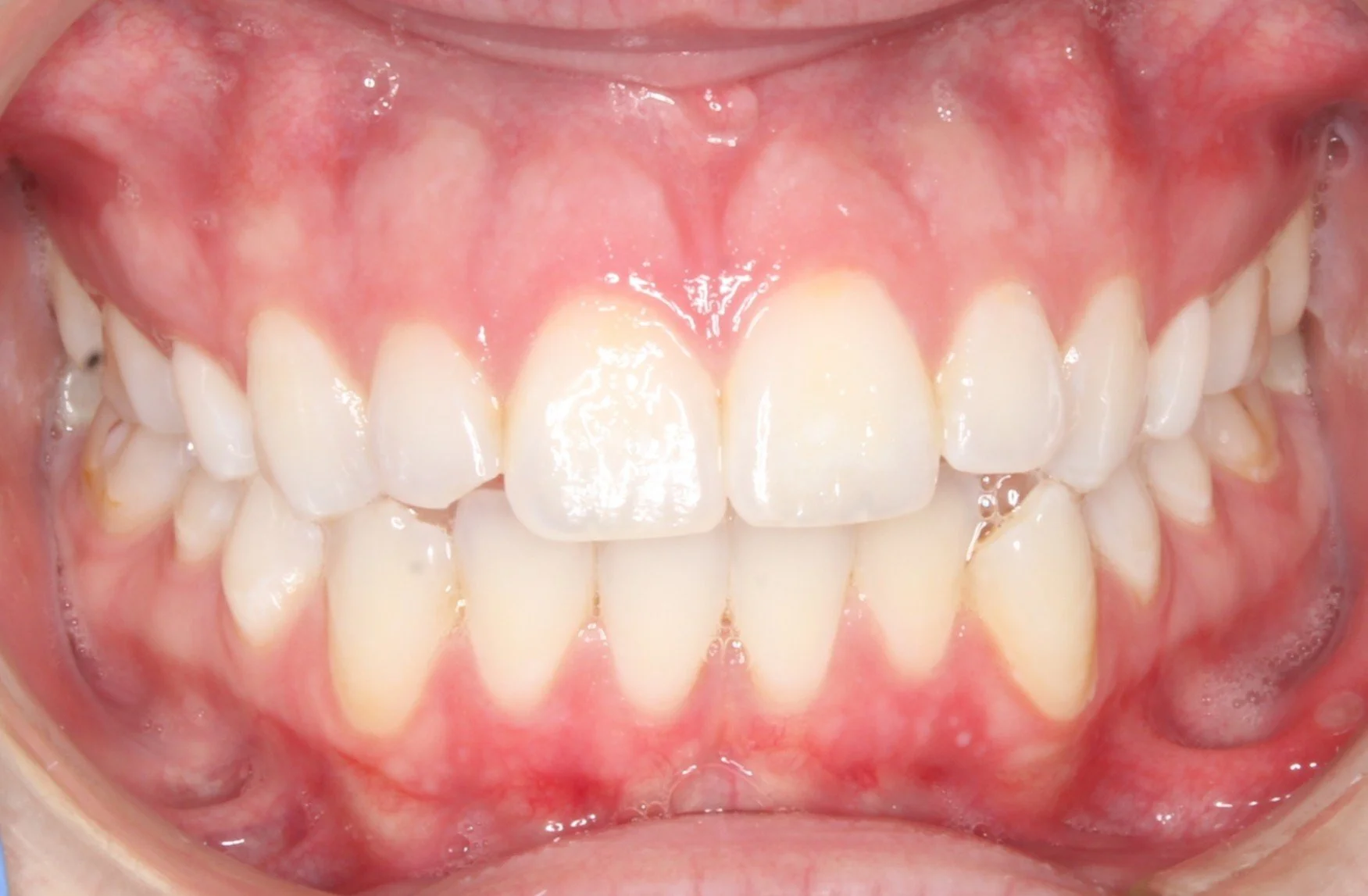 Close-up of human teeth and gums, showing upper and lower teeth with some slight misalignment.