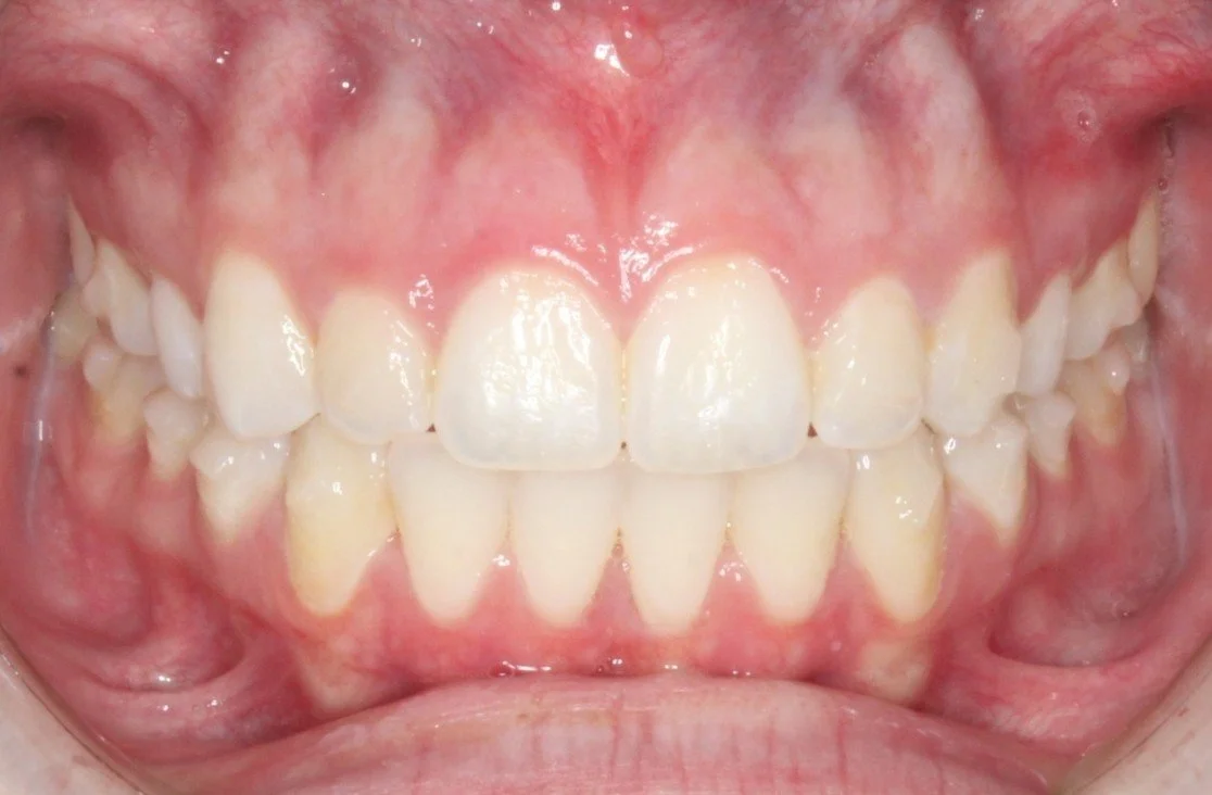 Close-up of a person's teeth showing misalignment and crowding.