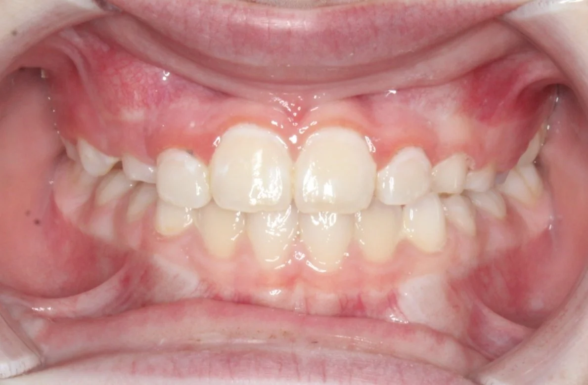 Close-up of a person's open mouth showing their teeth and gums, with mixed alignment and some crowding.
