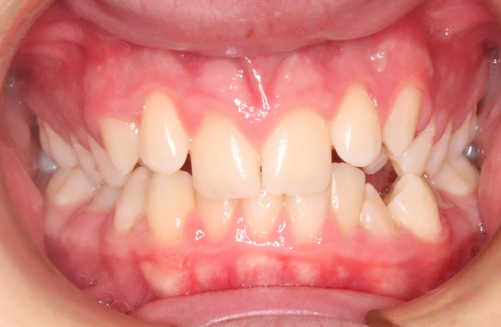 Close-up of a person's open mouth showing teeth and gums. Notable are several misaligned teeth, some crowding, and visible signs of dental issues.