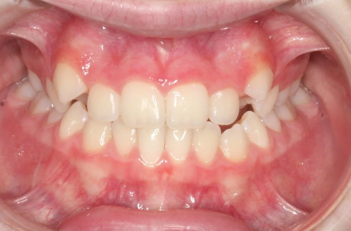 Close-up of a child's mouth showing mixed teeth, including adult and baby teeth, with some misalignment and crowding.