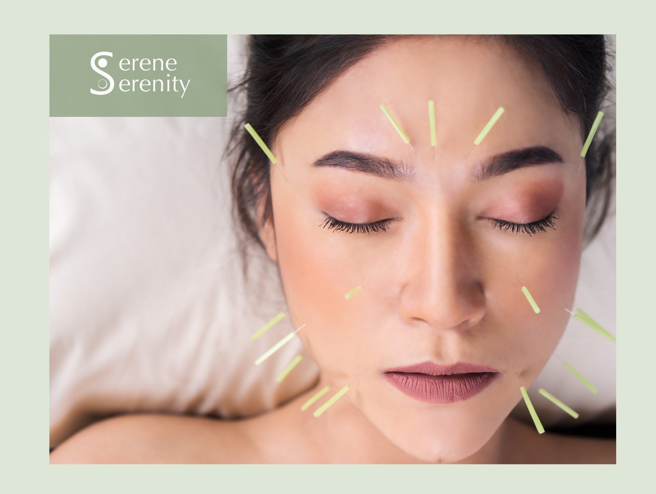 Close-up of a woman's face with acupuncture needles in her forehead and face, eyes closed, with a calm expression. facial acupuncture