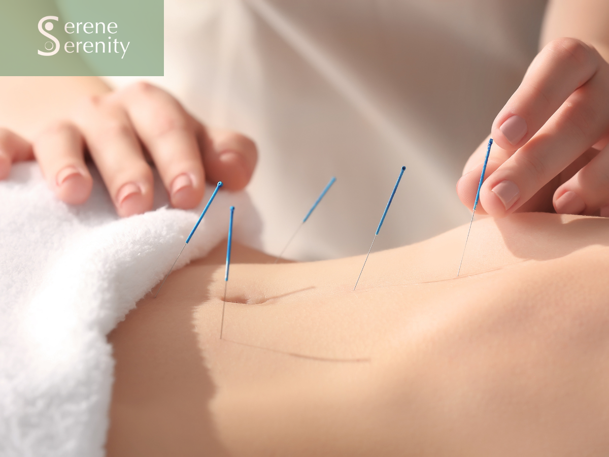 Acupuncture treatment with multiple acupuncture needles inserted into a person's skin in a clinical setting. acupuncture for pain and fertility