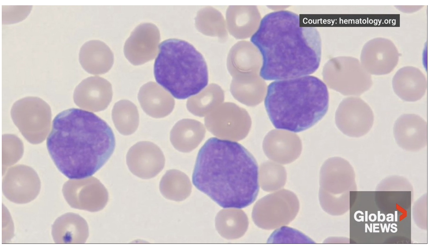 Young IWK patients with leukemia get to see disease at cellular level