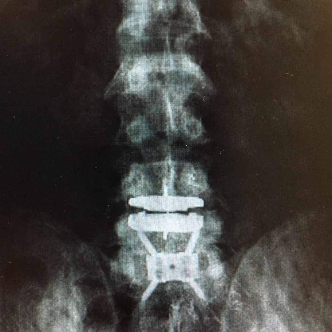 Artificial disc replacement, Gautham Prabhakar, spine surgeon in San Antonio, Texas at Texas Neuro Spine