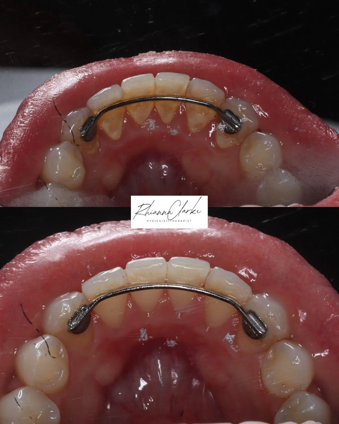 ✨Transformation Tuesday ✨

Before ➡️ After

It doesn&rsquo;t take long for plaque to harden into calculus around a fixed retainer. Because the wire sits close to the teeth, it creates extra little areas where plaque can hide, making it much harder to